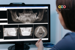 Dental implants in Indirapuram