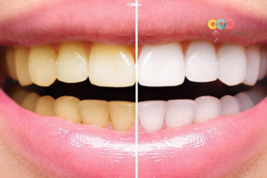 Teeth Whitening in Indirapuram