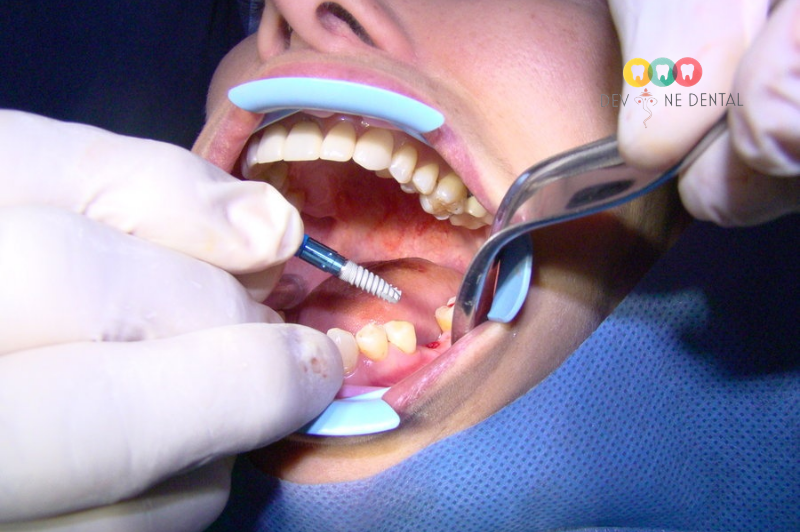 Root Canal Treatment in Indirapuram: When Do You Really Need It?