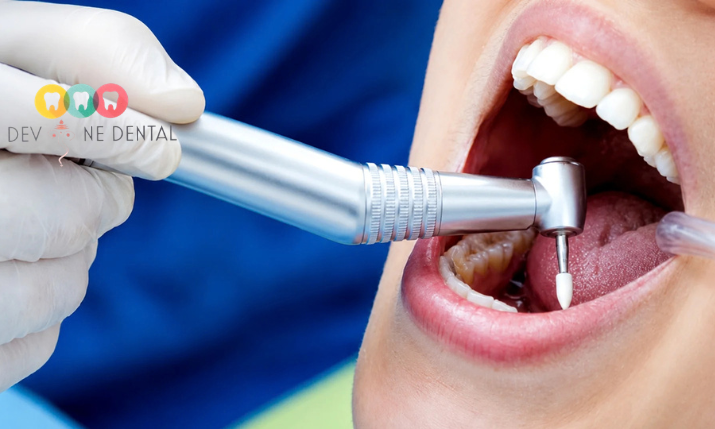 Broken or Chipped Tooth in Indirapuram