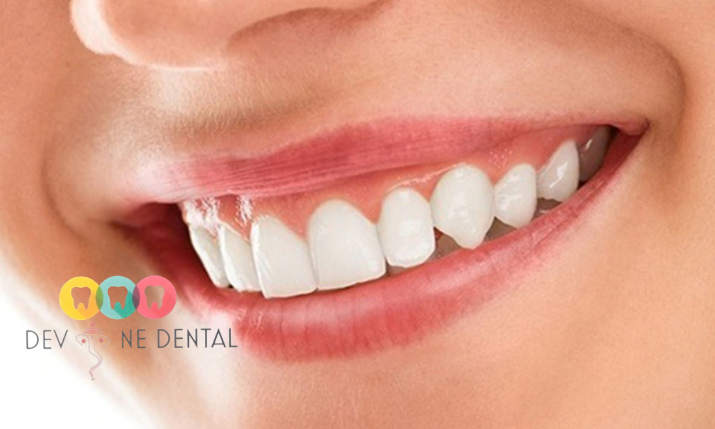 Smile Makeover in Indirapuram