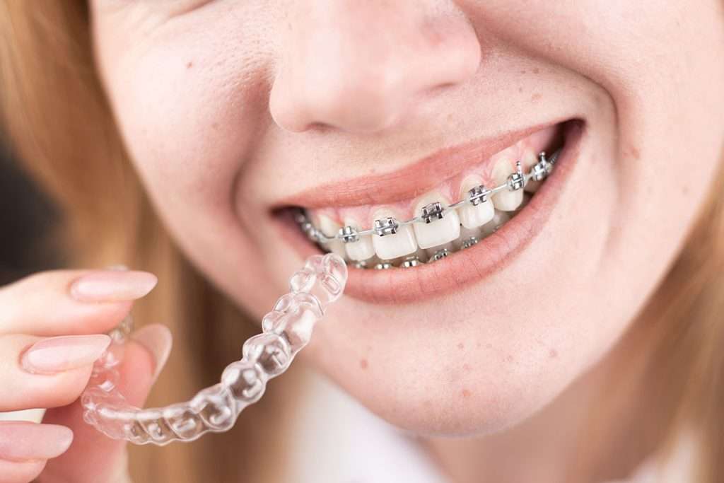 Braces-thumb