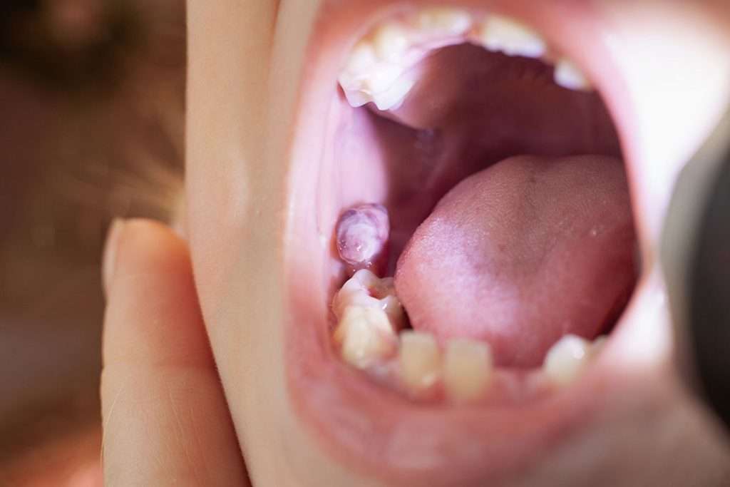 Cysts