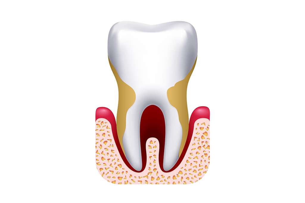 Emergence-and-Common-Issues-of-Wisdom-Teeth