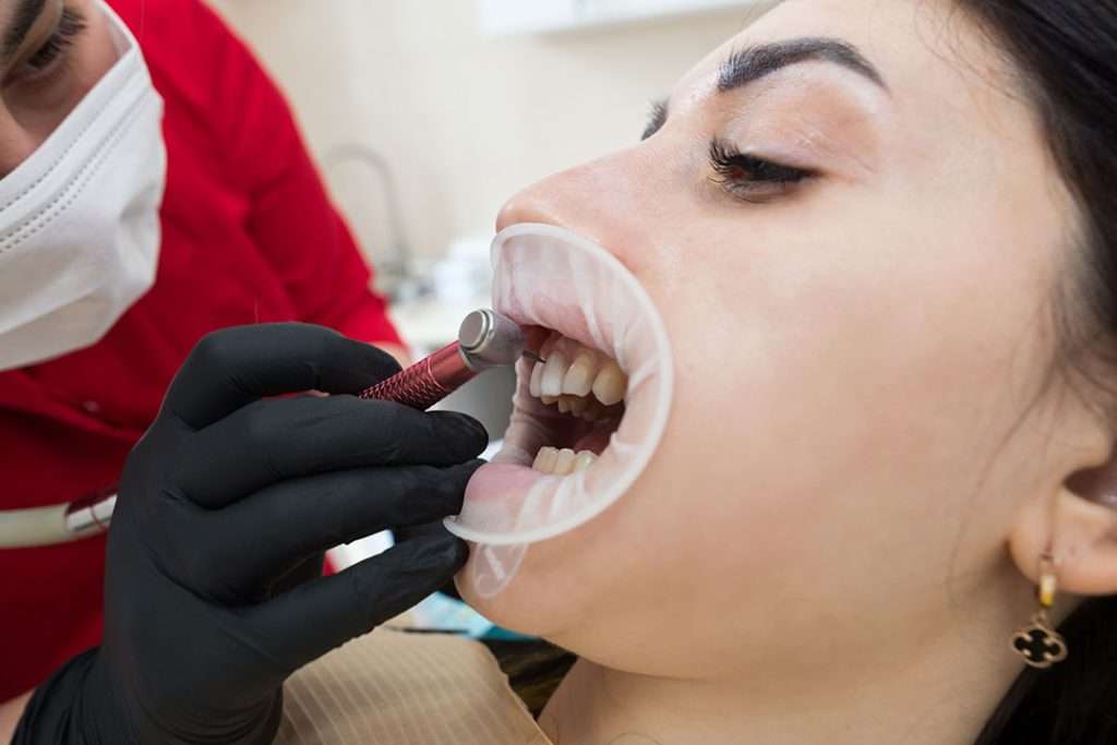 Gum-Contouring