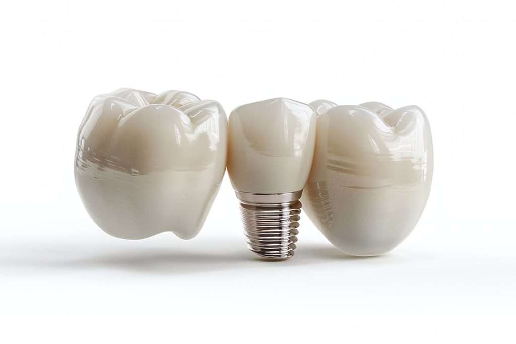 Implants