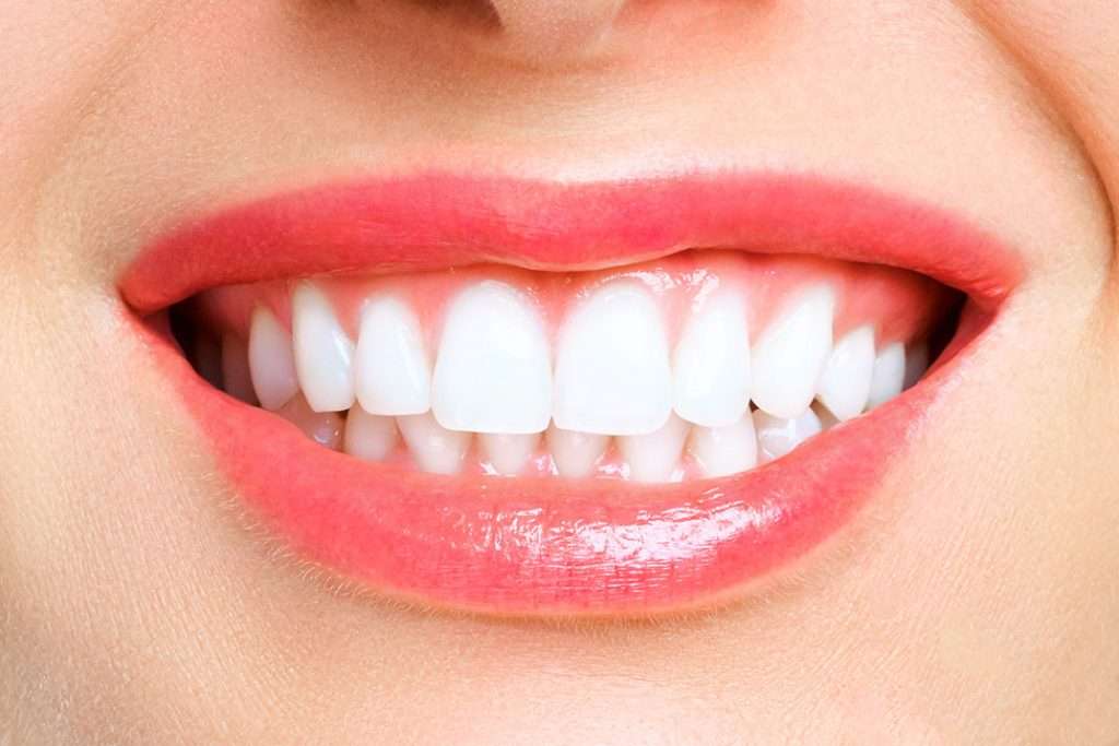Porcelain Veneers