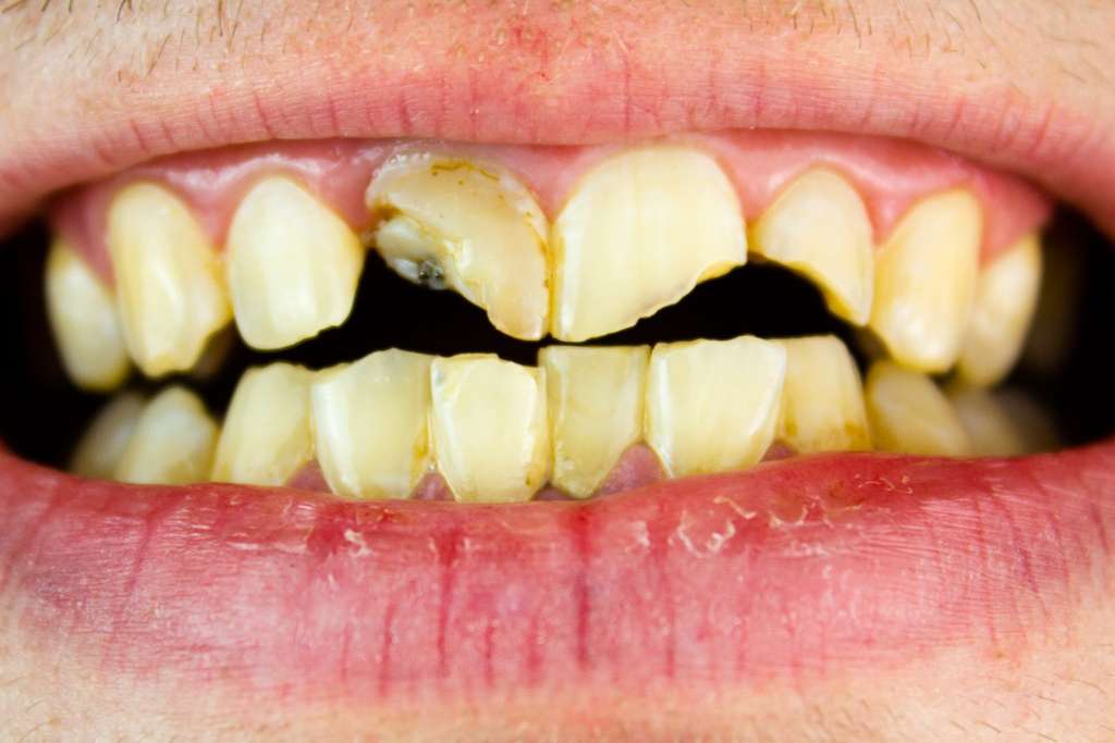broken-tooth