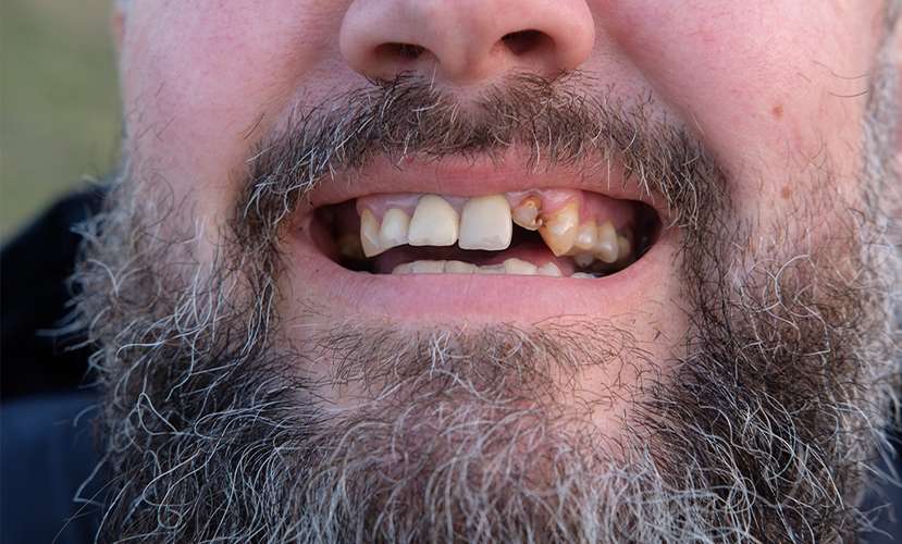 toothlos (1)